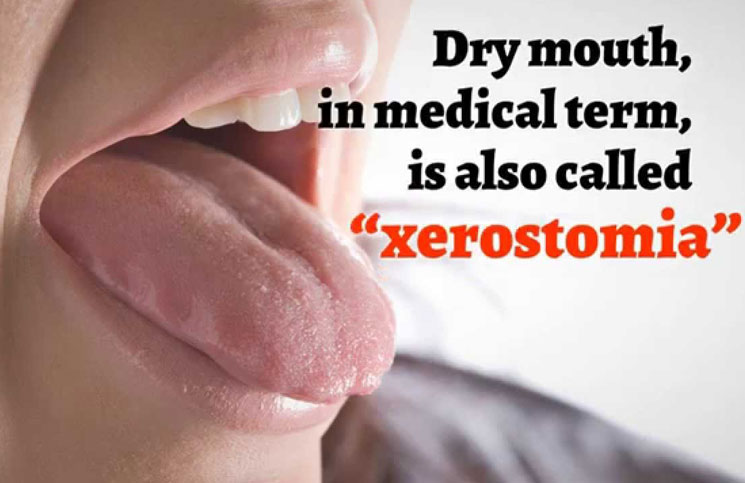 Multiple Myeloma Side Effect Xerostomia Aka Dry Mouth Therapy Peoplebeatingcancer