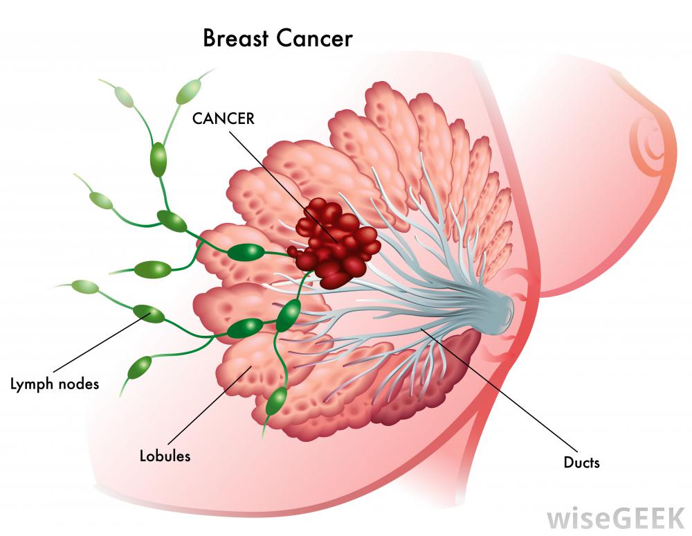 does breast cancer hurt