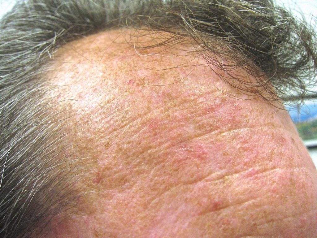 Actinic Keratosis Treating Pre Pre Skin Cancer Peoplebeatingcancer