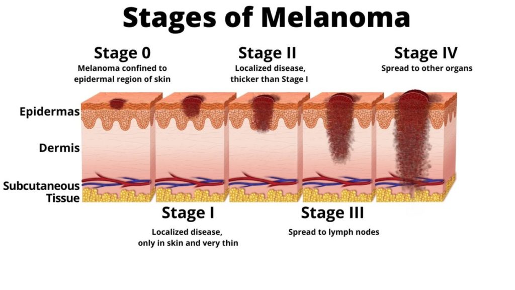 Melanoma In Situ Should You Worry Peoplebeatingcancer